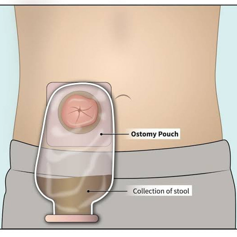 Ostomy and Colostomy Bags